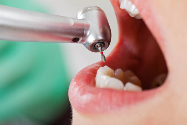 Best Broken or Chipped Tooth Repair in Grapevine, TX